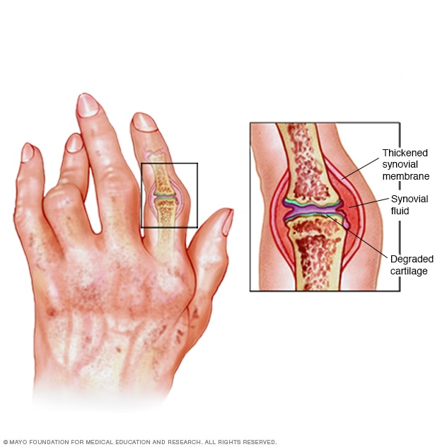 Featured image of post Rheumatoid Arthritis Pictures